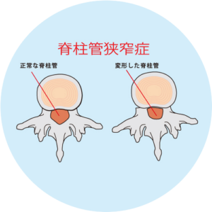 脊柱管狭窄症