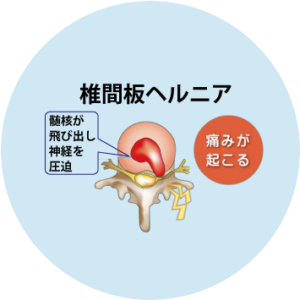 椎間板ヘルニア