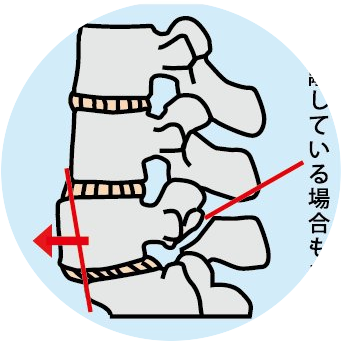 腰椎すべり症
