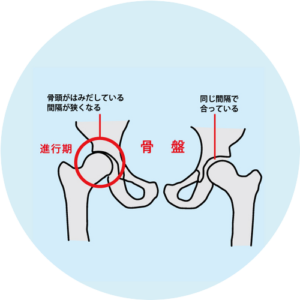 股関節の痛み