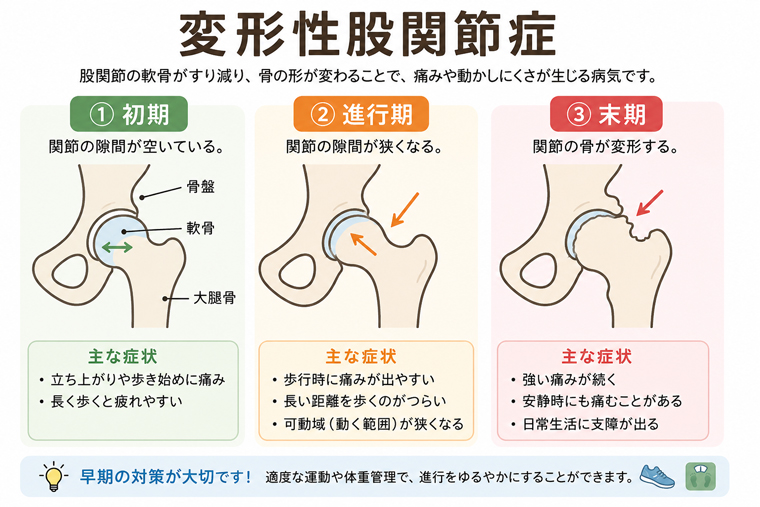 変形性股関節症のしくみ:股関節の変形をあらわした図